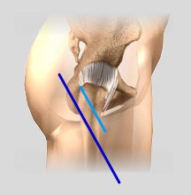 Minimally Invasive Knee Replacement Incisions